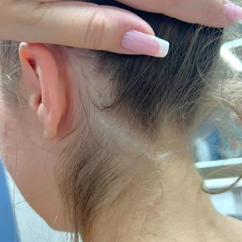 Detail chloupků na hrudi a krku před laserovým ošetřením